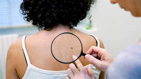 Visit The Most Recommended Skin Cancer Doctor In Case You Find Spots On