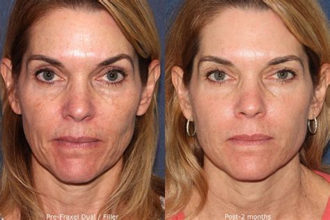 Fine Lines And Wrinkles Treatment San Diego Ca Clderm