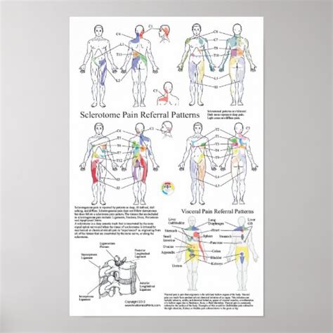 Sclerotome Visceral Pain Referral Chart Poster