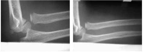 Monteggia Fracture Dislocation In Children Teachme Orthopedics