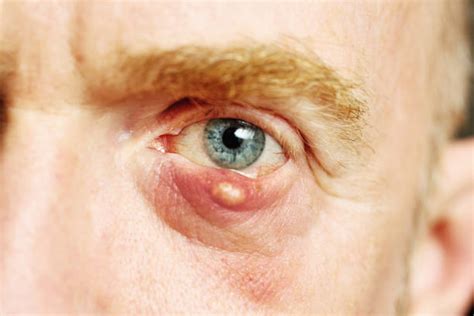 Sebaceous Cyst On Eyelid Ph