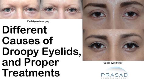 What Causes A Droopy Eye Dr Amiya Prasad Blog