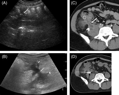 An abdominal muscle strain may cause pain; A 34-year-old female patient presented with right lower abdominal pain... | Download Scientific ...