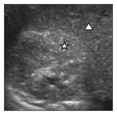 Renal Ultrasound A Sagittal Left Kidney Echogenic Pyramids
