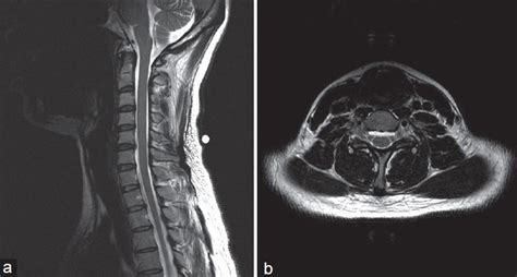 Sagittal A And Axial B T2 Weighted Image Mri Scans Of The Cervical