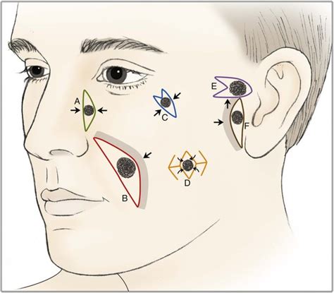 Reconstruction Of The Cheek Clinical Gate