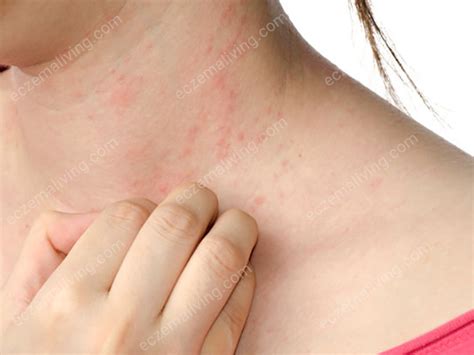 Eczema On Neck How To Get Rid Of Neck Eczema