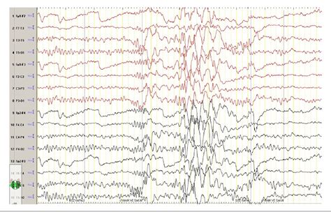 Figure 1 From Agenesis Of The Corpus Callosum And Generalized Epilepsy