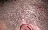 Small Red Itchy Pimples on Scalp Cause and Treatment - Skincarederm