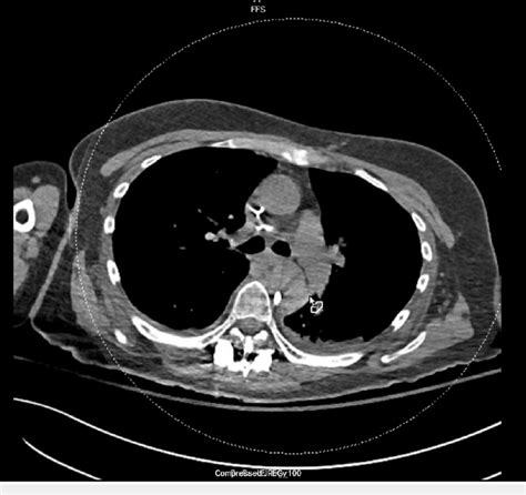 Computed Tomography Ct Scan Of The Chest Download Scientific Diagram