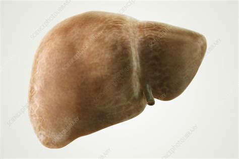 Fatty Liver Artwork Stock Image C0205743 Science Photo Library