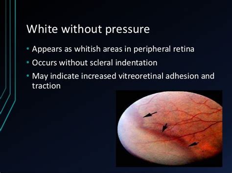 High Myopia And Management