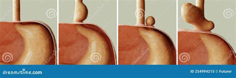 Types Of Hiatal Hernias Sliding And Paraesophageal Cartoon Vector