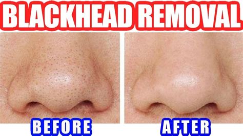 How To Remove Blackheads Best Blackhead Removal Easy Tool Youtube