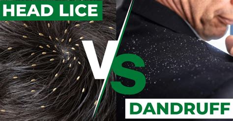 Head Lice Symptoms And Causes Prevention Style Vanity