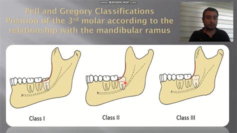 Management Of Impacted Lower 3rd Molars Part I Youtube