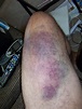 The thigh – bruise update – Dan Langille's Other Diary