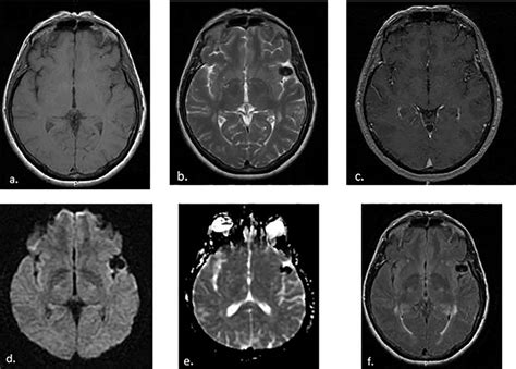 The Lesion Is Isointense On T1 Weighted Images A Hypointense On T2