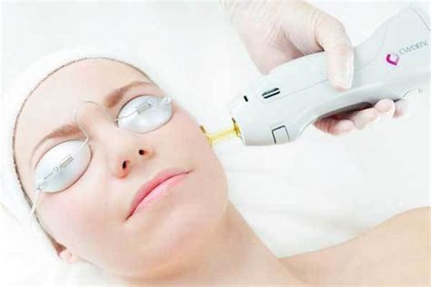 ما هي أنواع ليزر الوجه وفوائده وأضراره رائج