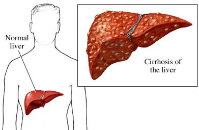 What improvements do patients get? Cirrosis