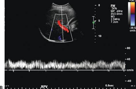 gallery  normal portal vein ultrasound