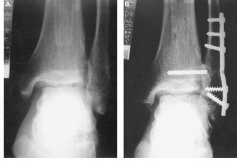 Figure 3 From Corrective Elongation Osteotomy Without Bone Graft For