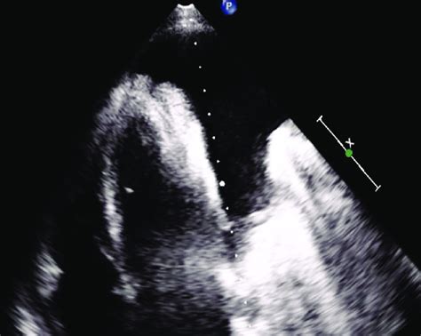 Cect Thorax Shows Superior Vena Cava Thrombosis And Left Massive