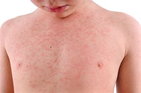What The Meningitis Rash Looks Like And How To Identify Nine Other