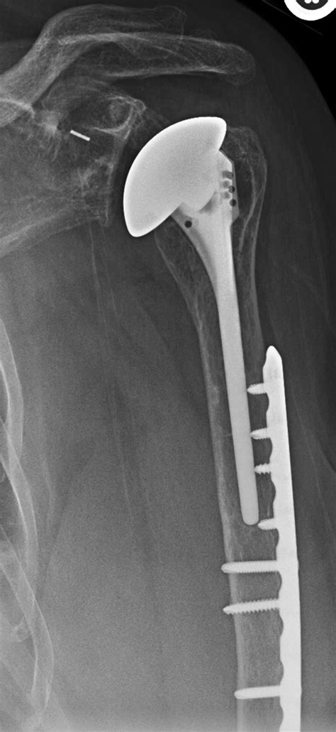 Uw Shoulder And Elbow Academy Shoulder Joint Replacement Humeral