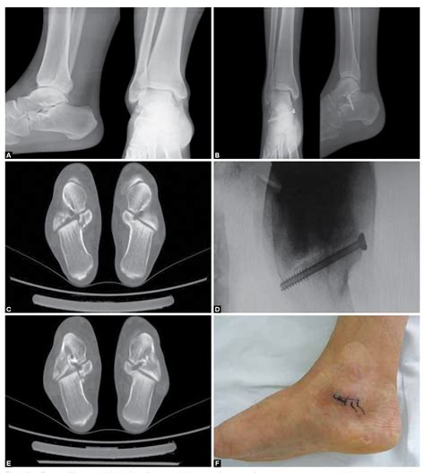 Figure 1 From Isolated Fractures Of The Sustentaculum Tali Injury