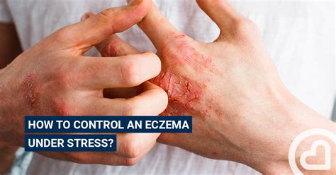 How To Control An Eczema Under Stress Articles Familiprix