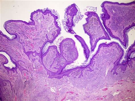 Pathology Outlines Common Nevus