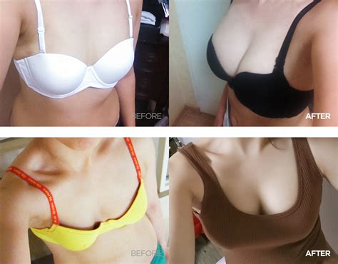 Albright, board certified plastic fat transfer or grafting to the breast is one of the more exciting current techniques in breast surgery. Breast Augmetnation - Fat Grafting - GRAND PLASTIC SURGERY