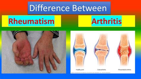 Difference Between Rheumatism And Arthritis Youtube
