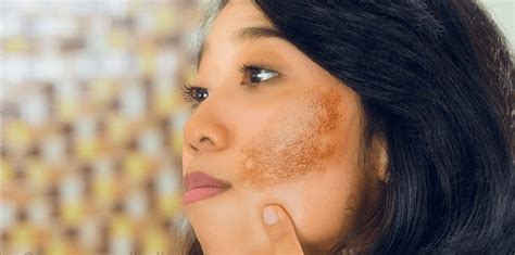 What Is The Difference Between Freckles And Melasma Euromed® Clinic
