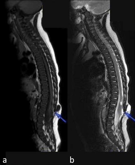 Whole Spine Sagittal T A And T Weighted B Mri Showing The Single