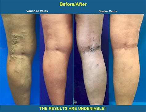The Before And After Transformation Vein Specialists Of The Carolinas