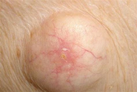 Underarm Cyst Symptoms Causes Pictures Removal Treatment Home