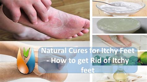 Natural Cures For Itchy Feet How To Get Rid Of Itchy Feet Youtube