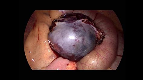 Laparoscopic Enucleation Of Right Ovarian Dermoid Cyst Youtube