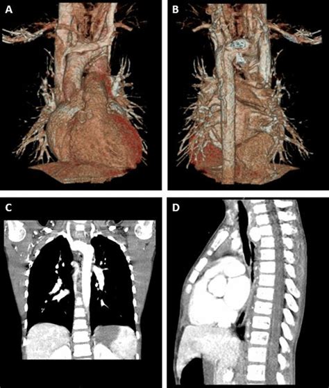 Preoperative Imaging Three Dimensional Computed Tomographic