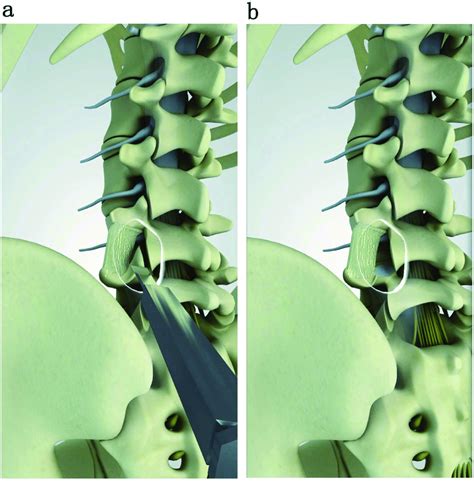 They Show That Only L5 Superior Facet Joint Was Removed By Ostetome