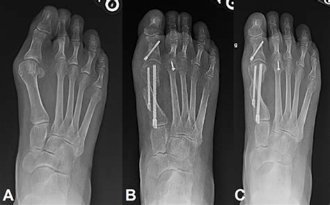 Minimally Invasive Bunion Surgery Footcaremd