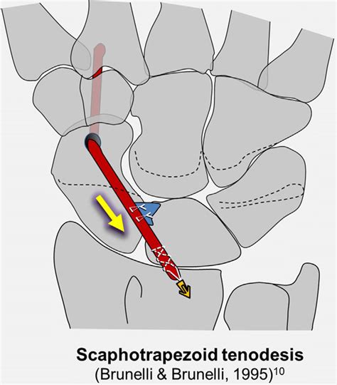 Diagram Of Brunelli Scaphotrapezoid Tenodesis Technique 26