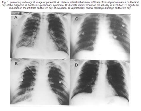 Researchers say they have identified eight different types of skin rash which could be a potential sign. hantavirus: Hantavirus Pulmonary Syndrome Symptoms