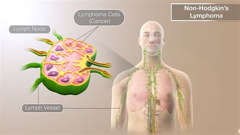 Non Hodgkins Lymphoma Shown And Explained Using Medical Animation