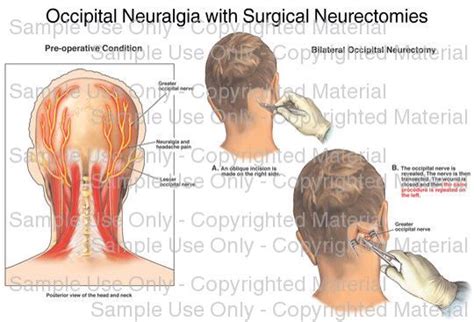What Is Occipital Neuralgia And How It Links With Fib Vrogue Co