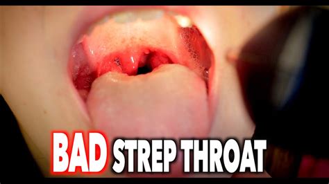 Bad Strep Throat With Swollen Nodes Dr Paul Youtube