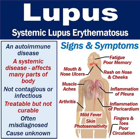 Lupus Causes Symptoms And Research 56 Off