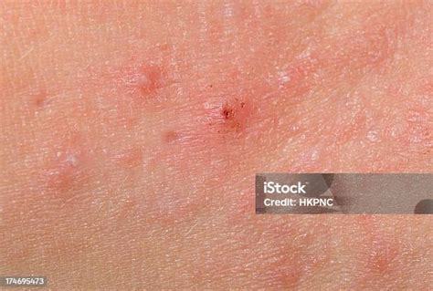 Red Skin Rash With Bumps Scabs Pimples On Child Stock Photo Download